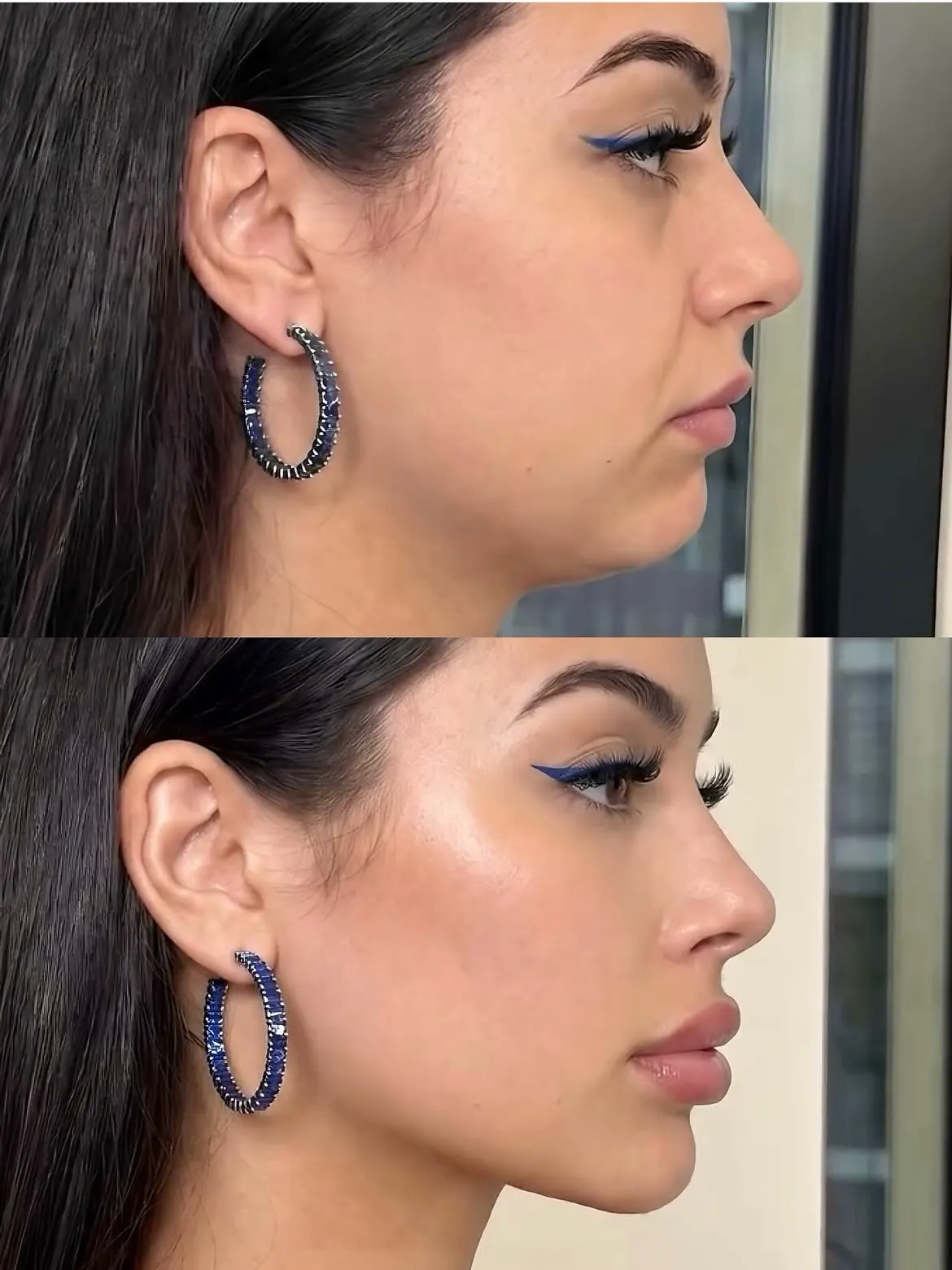 Clear mandibular contour visual reference
