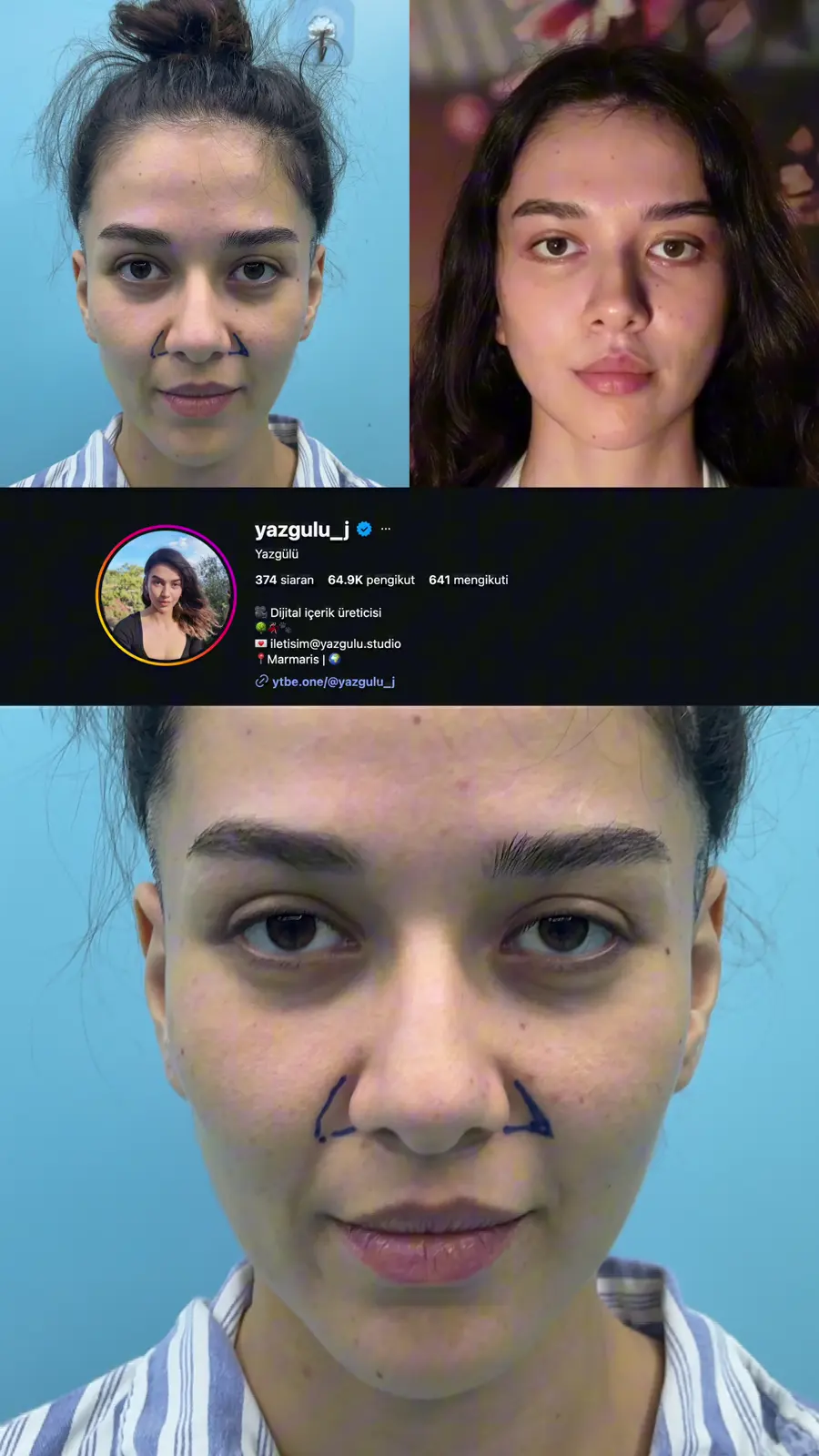 A creator documents her first month of recovery.